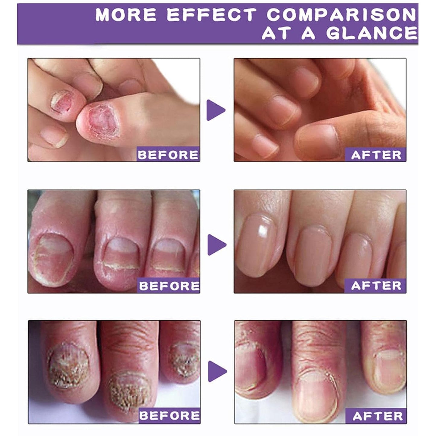Nail Serum For Complete Nail Protection ( pack of 2 )