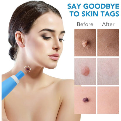 Woman with a skin tag on her neck, with before and after images of skin tag removal on the right.